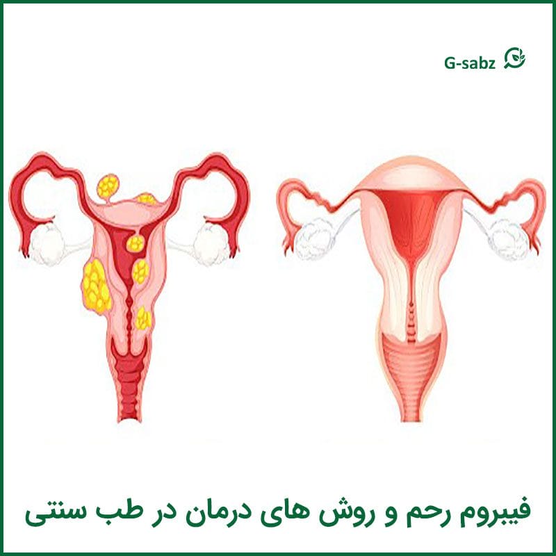 فیبروم رحم و روش های درمان در طب سنتی